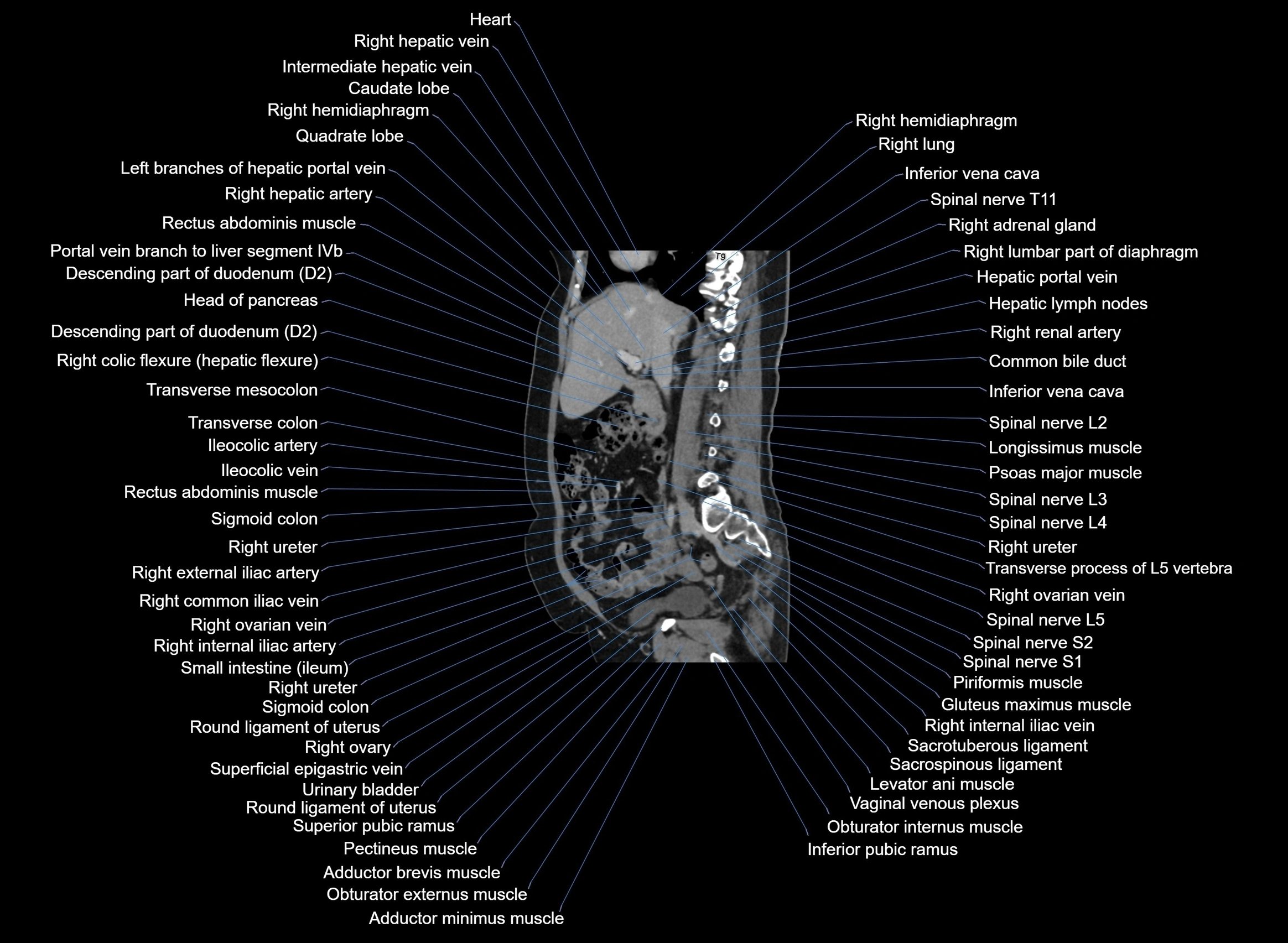 CT Abdomen sagittal cross sectional anatomy labelled radiology image -00070.webp